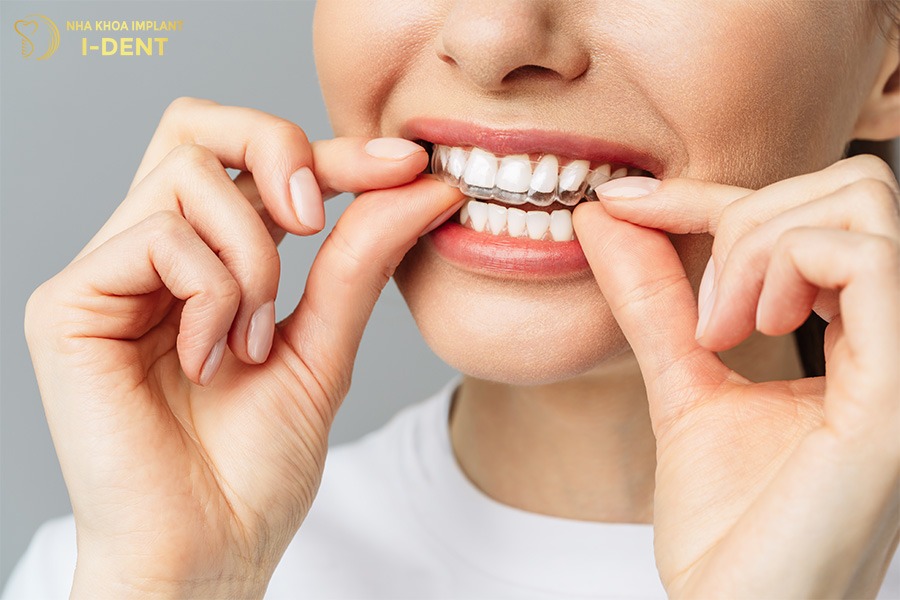 niềng răng vô hình giá