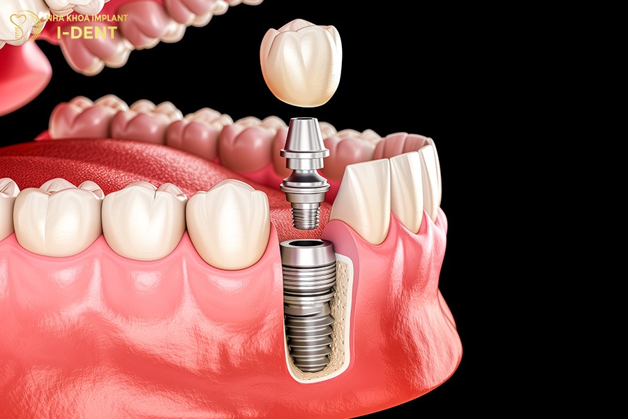 Cấy ghép implant là giải pháp toàn diện phục hồi răng số 6.