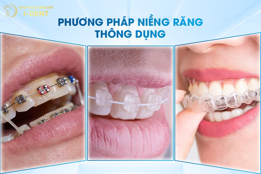 Phương pháp niềng răng cho trẻ 6, 7, 8 tuổi