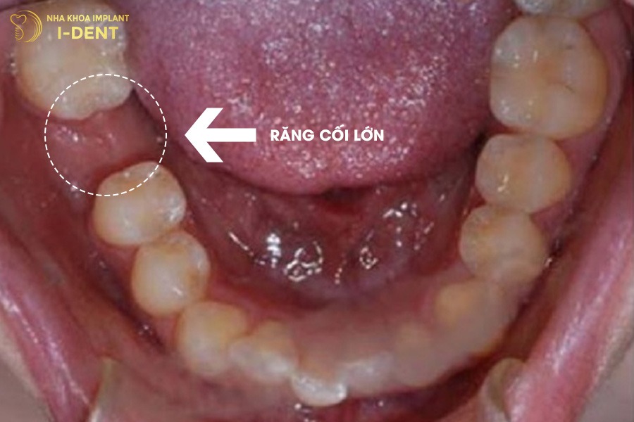 Răng số 6 là răng cối lớn đảm nhiệm chức năng nghiền nát thức ăn.