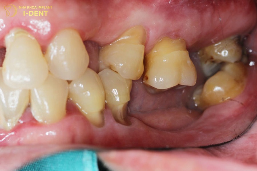 Răng lung lay, yếu và đau khi nhai.