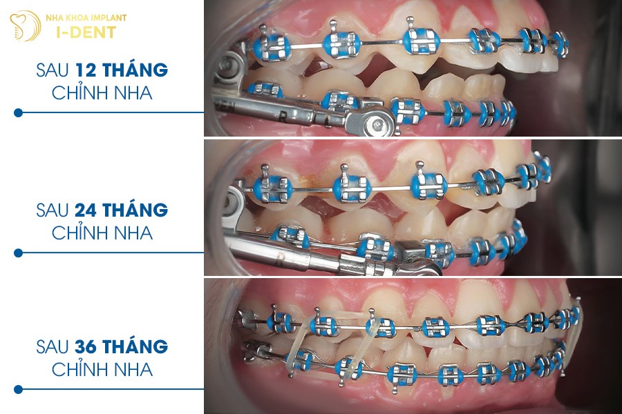 Thời gian niềng răng 19-20 tuổi từ 18 - 36 tháng
