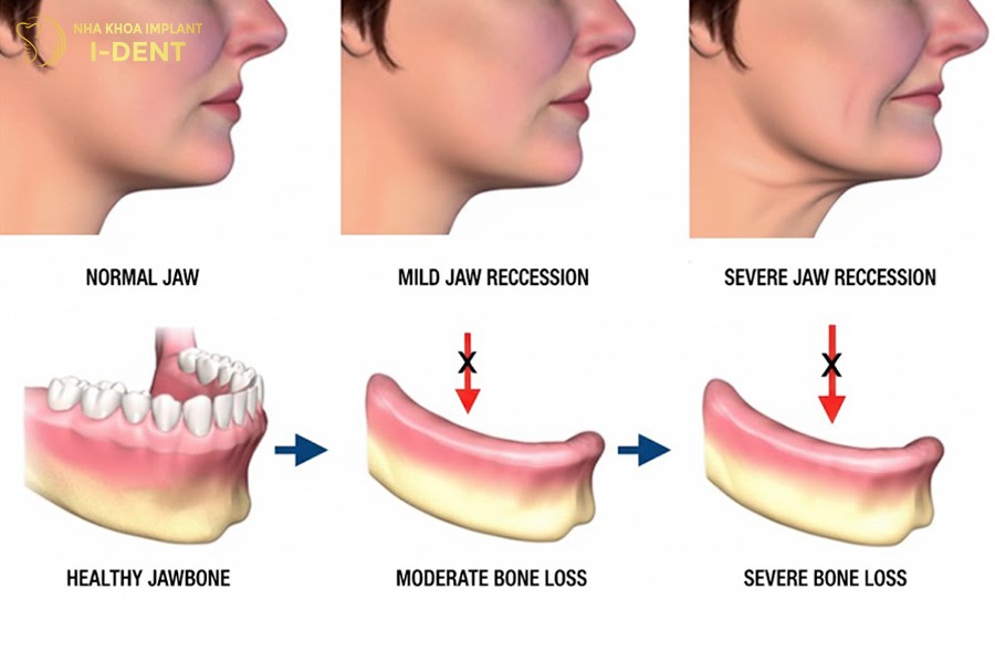 Xương hàm tiêu biến nhanh chóng sau khi mất răng.