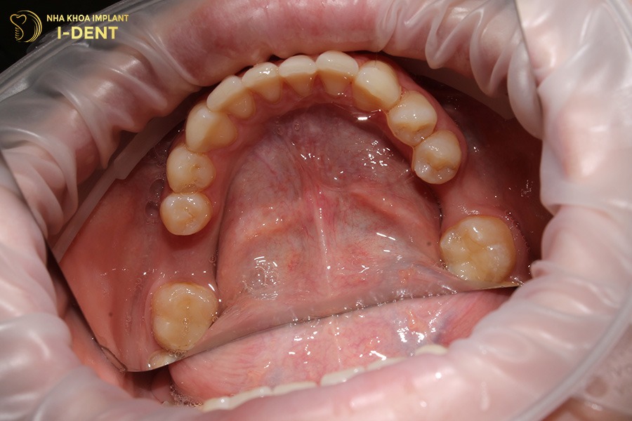 Sau khi mất răng, vùng xương ổ răng dần thu hẹp và lõm sâu.