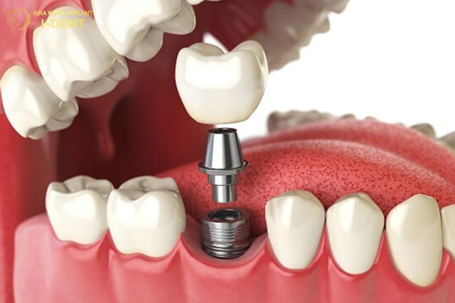 Trồng răng implant là giải pháp phục hình răng hiệu quả khi bị mất răng