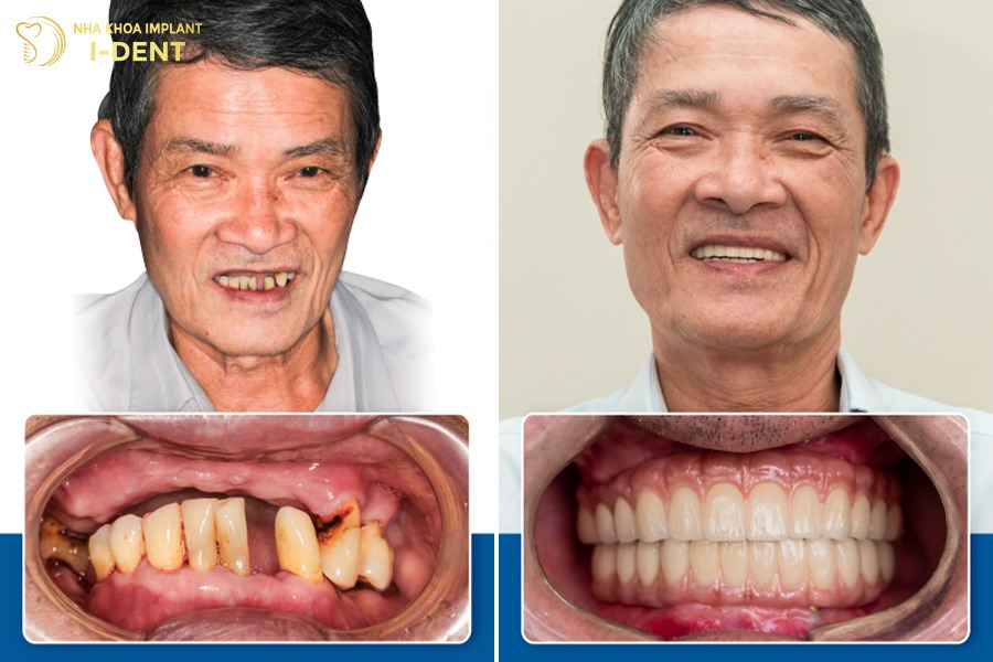 Trồng răng Implant giúp lấy lại nụ cười tự tin.