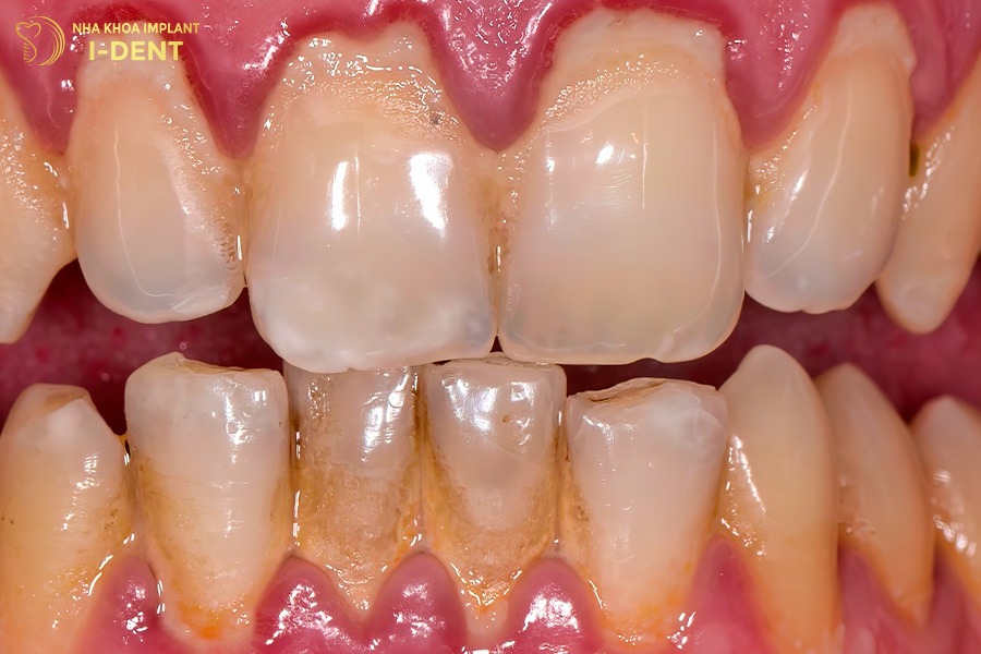 viêm nha chu gây rụng răng