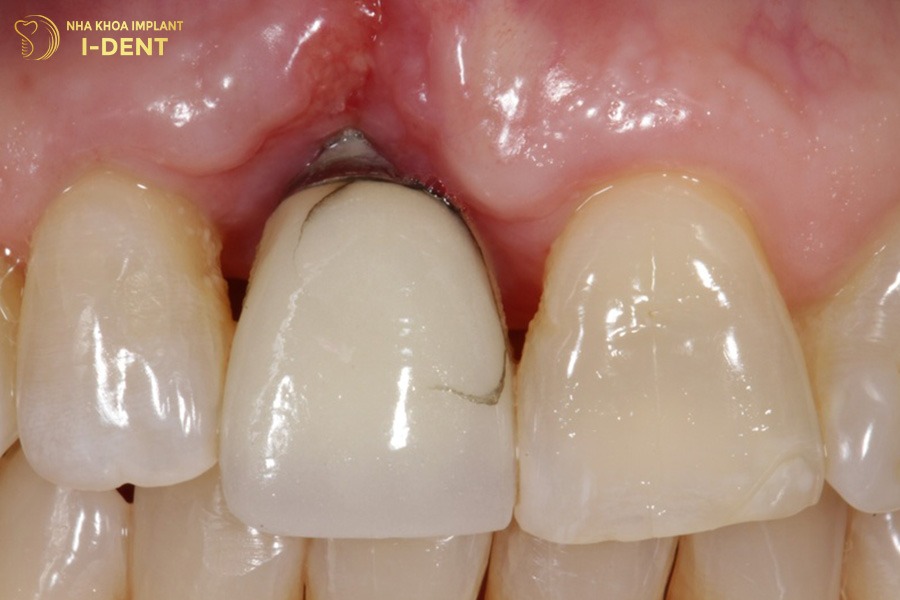 Không chăm sóc đúng cách sau cấy ghép có thể gây viêm quanh trụ.