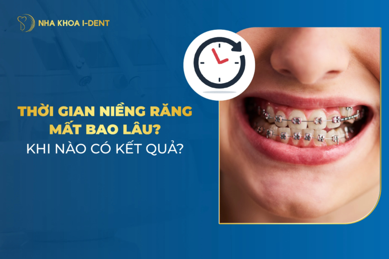 Thời Gian Niềng Răng Mất Bao Lâu? Khi Nào Tháo Được?