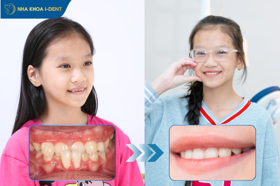 bao nhiêu tuổi niềng răng được
