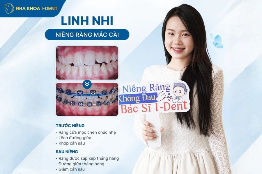 làm răng sứ rồi có niềng được không