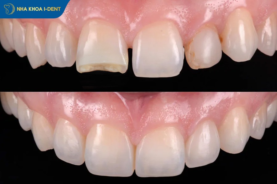 Bọc răng sứ để phục hồi răng cửa bị gãy