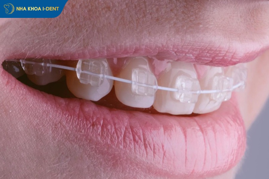 các loại niềng răng