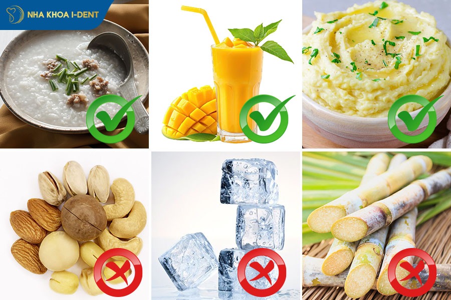 Cân nhắc chế độ ăn uống phù hợp để đảm bảo sức khỏe và phục hồi răng cửa