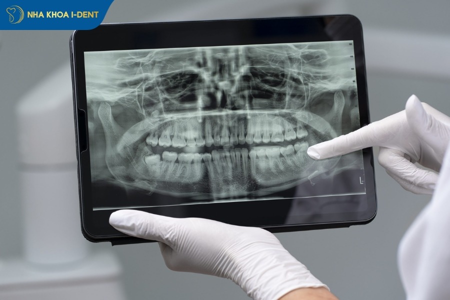 chụp x-quang kiểm tra răng