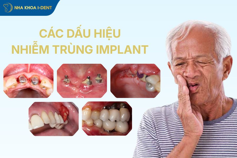 dau-hieu-nhiem-trung-implant