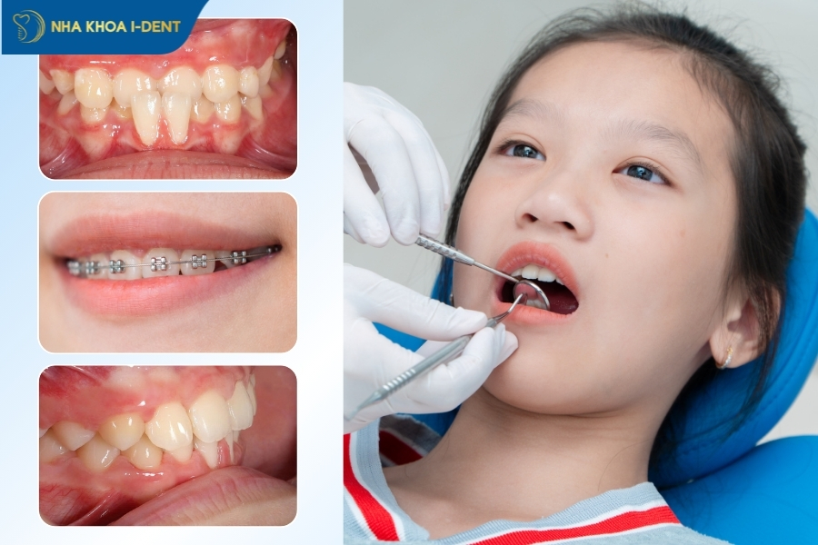 niềng răng ở độ tuổi nào tốt nhất