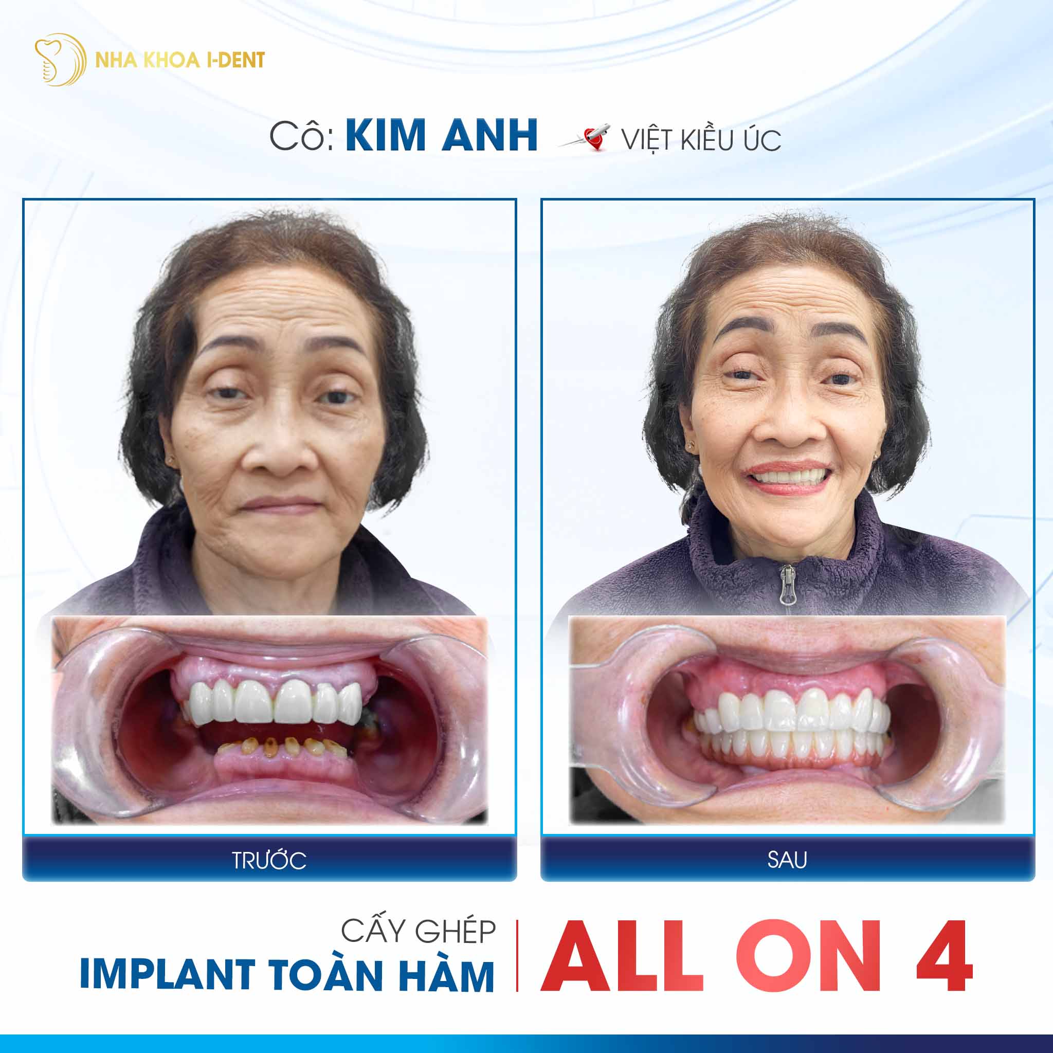 khách hàng đã trồng implant