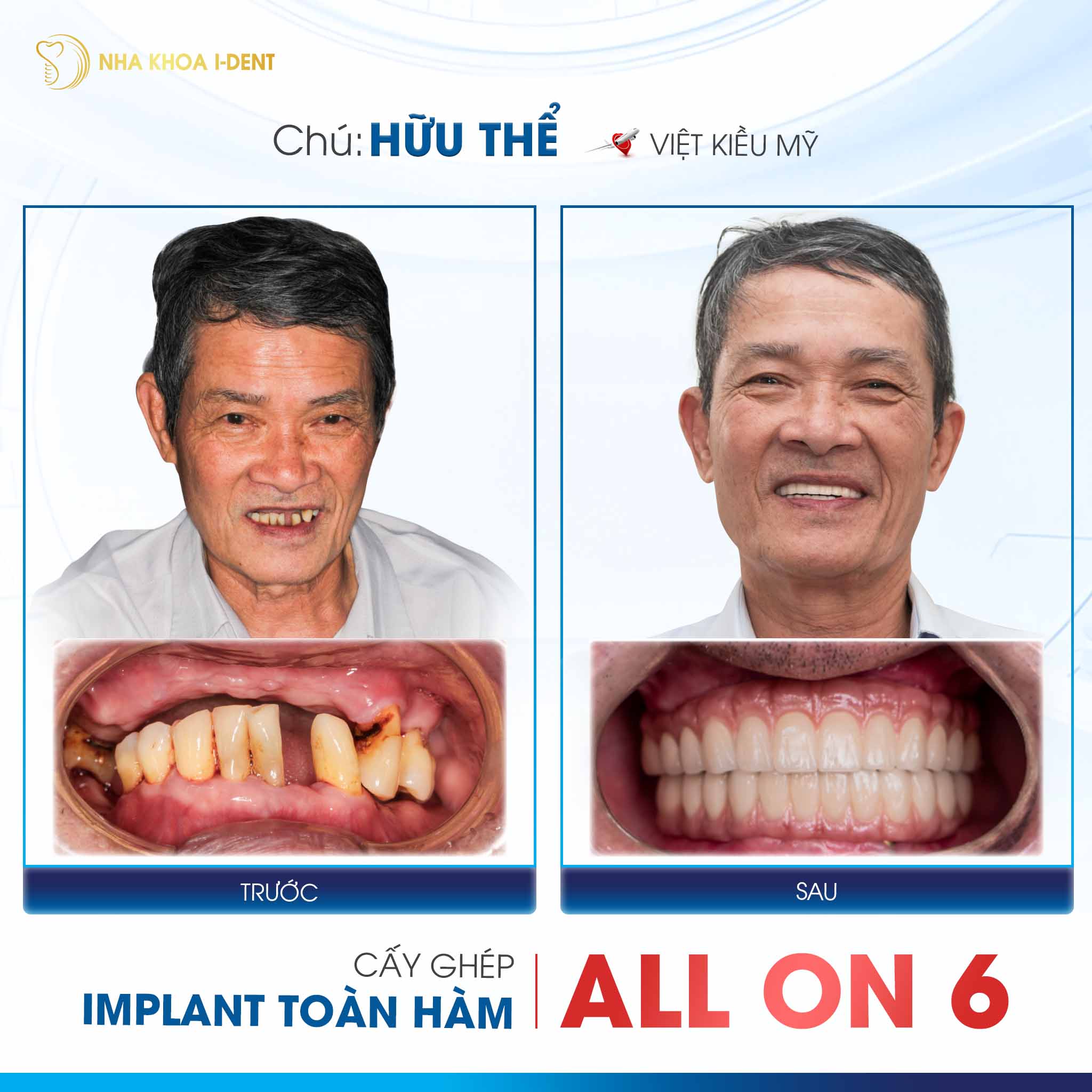 khách hàng cấy răng implant