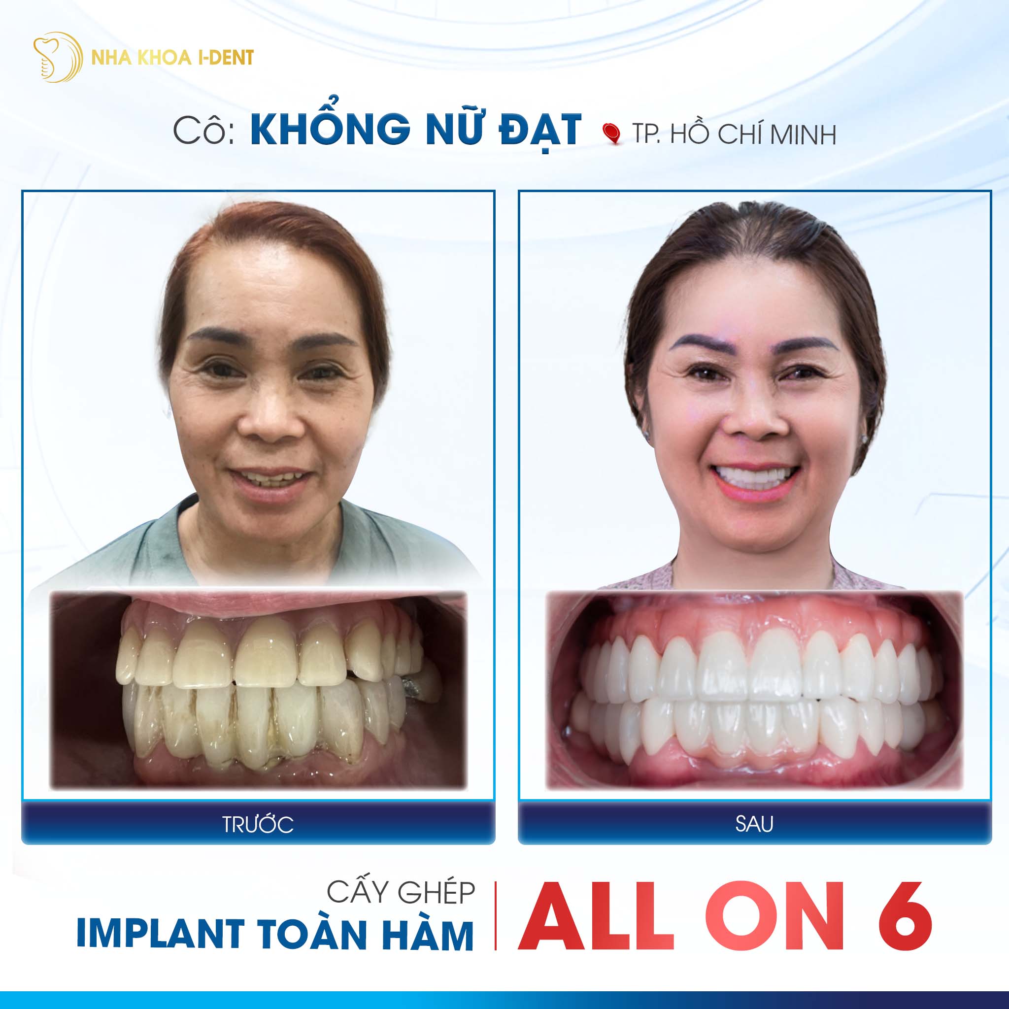 khách hàng trồng răng implant