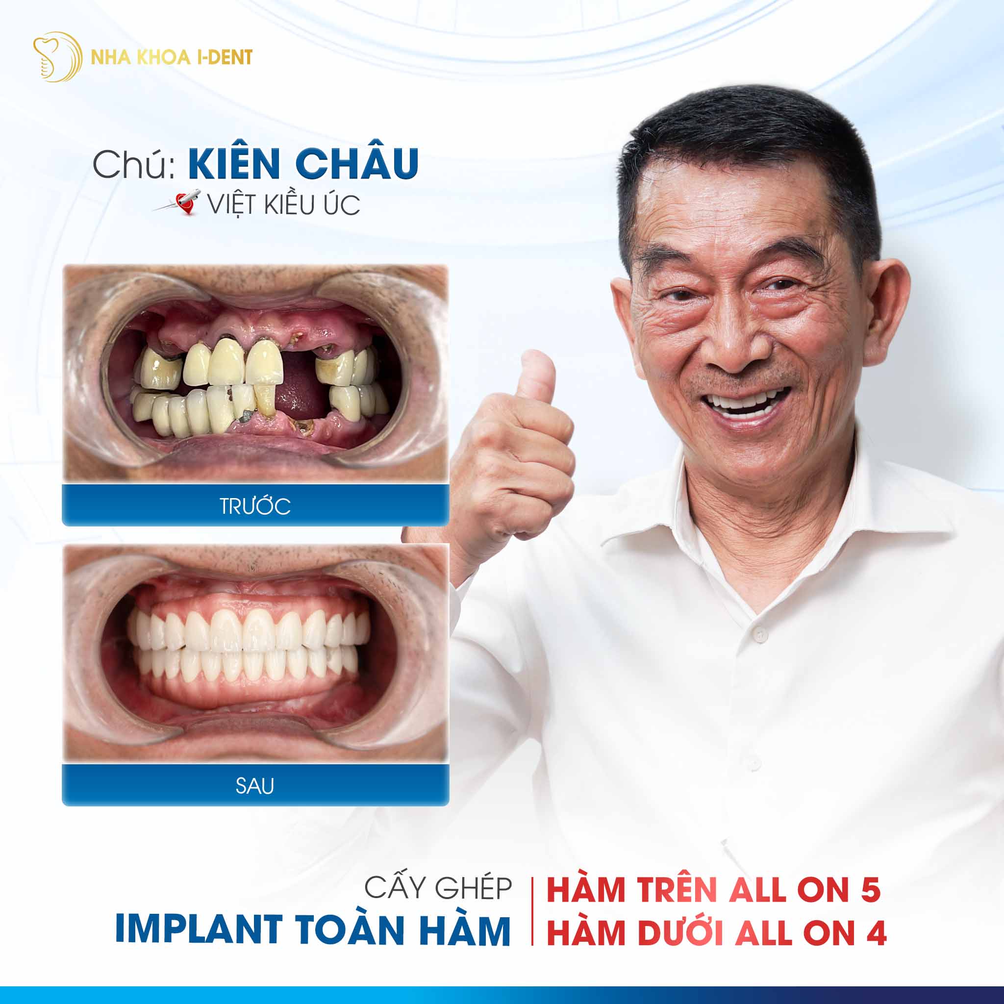 khách hàng cấy ghép implant