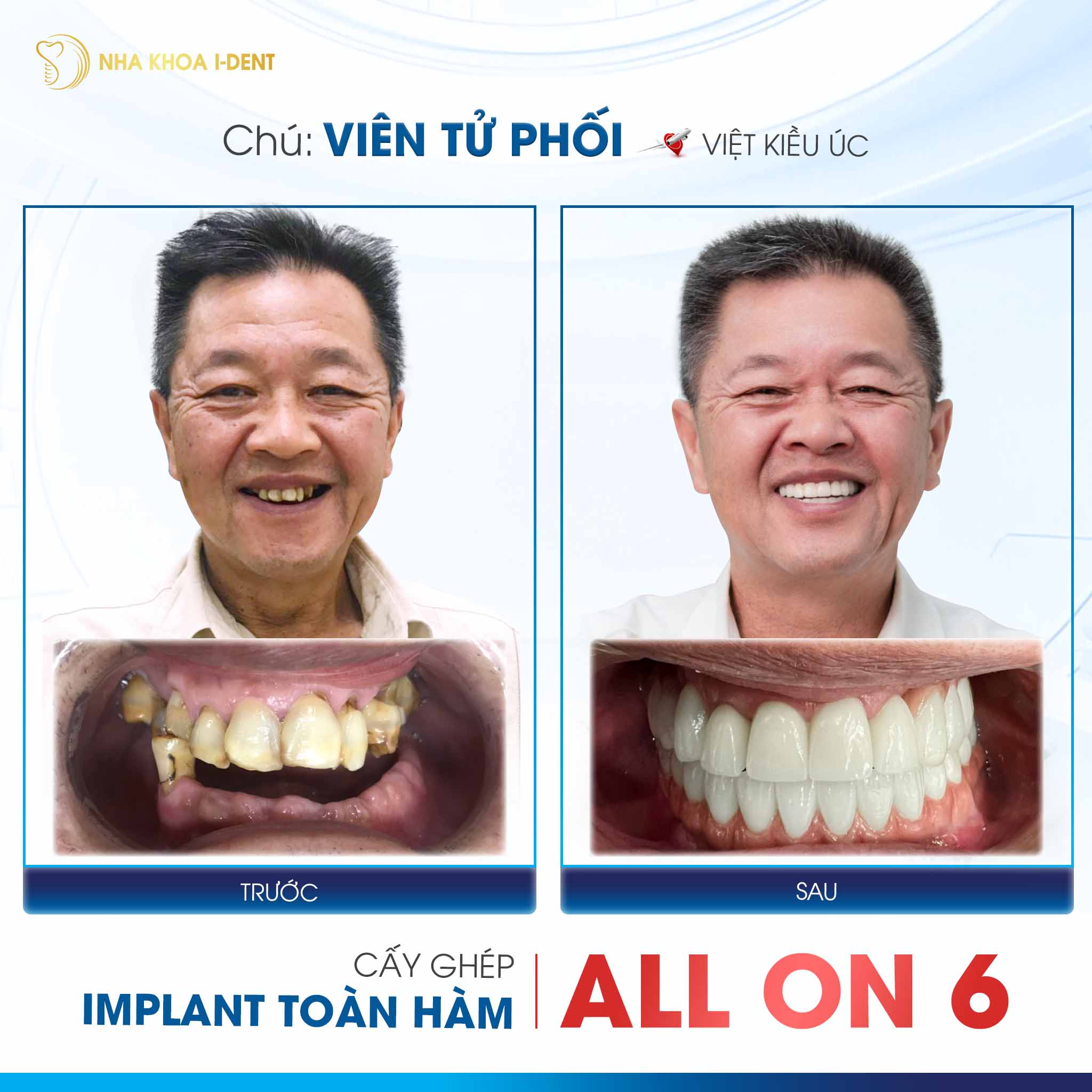 khách hàng làm răng implant