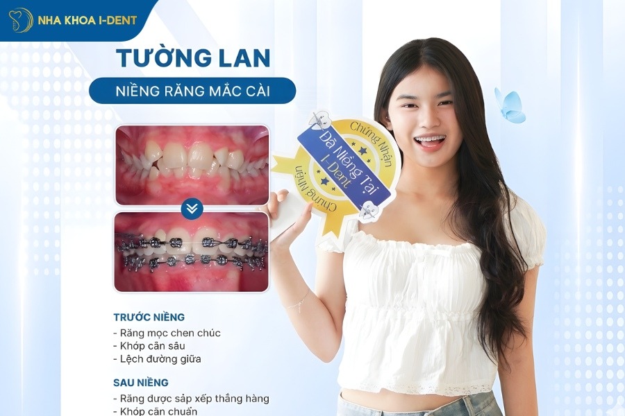 bọc răng sứ có niềng răng được không