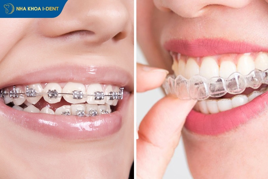 làm răng sứ rồi có niềng được không