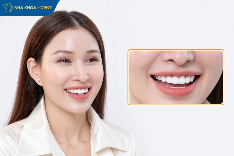 làm răng thỏ giá bao nhiêu