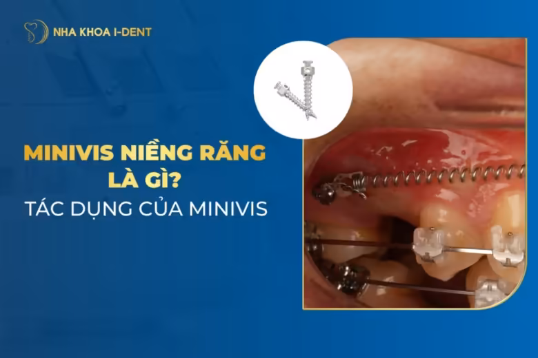 minivis niềng răng
