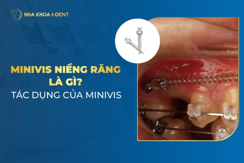 Minivis Niềng Răng Có Tác Dụng Gì? Có Đau Không?