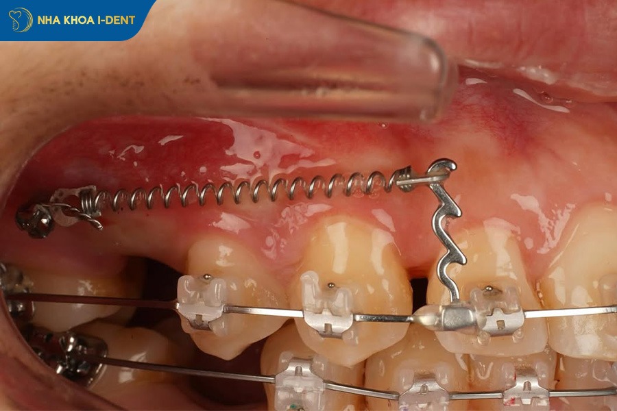 minivis niềng răng