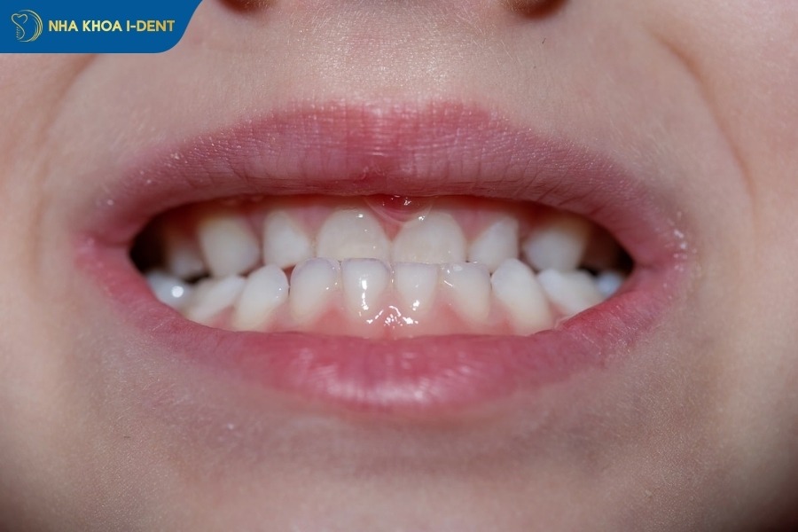 móm răng ảnh hưởng khuôn mặt