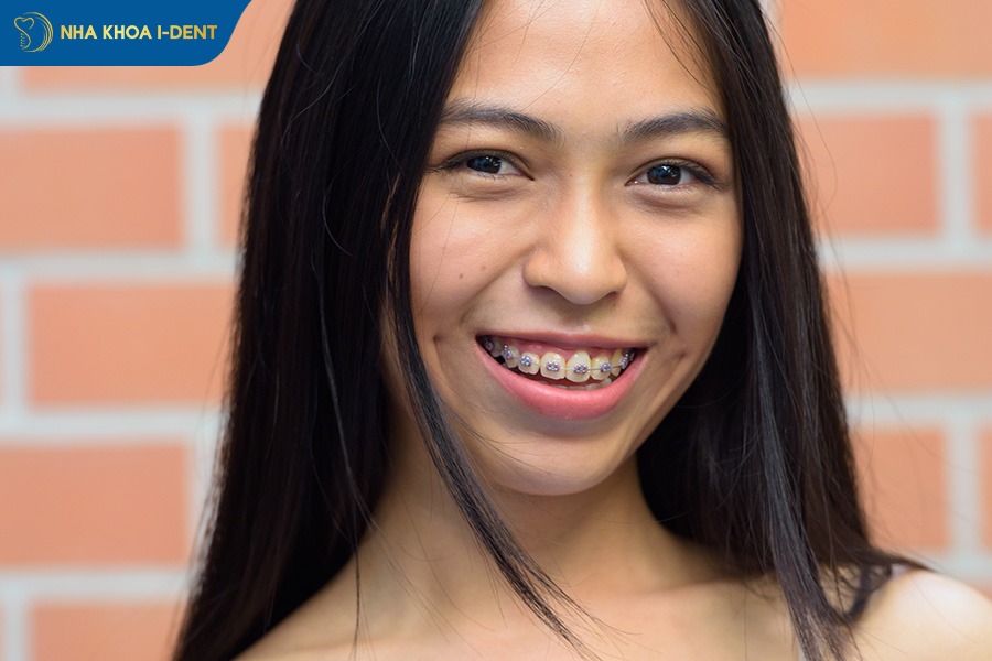 nên niềng răng loại nào