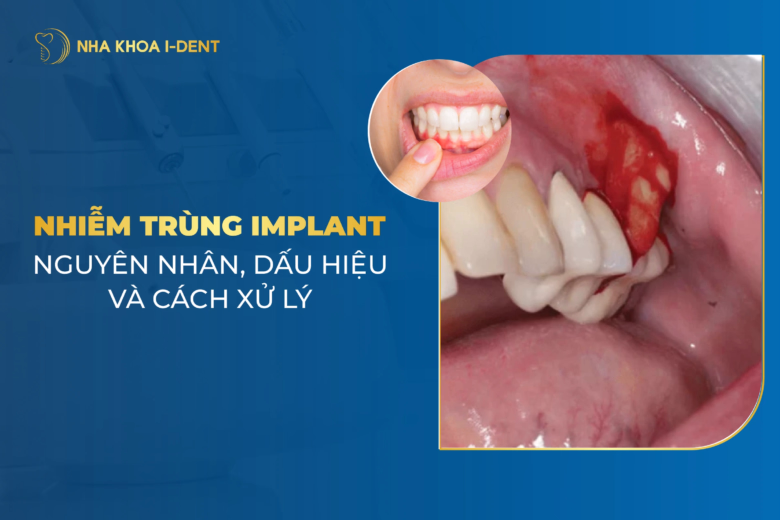 nhiem-trung-implant