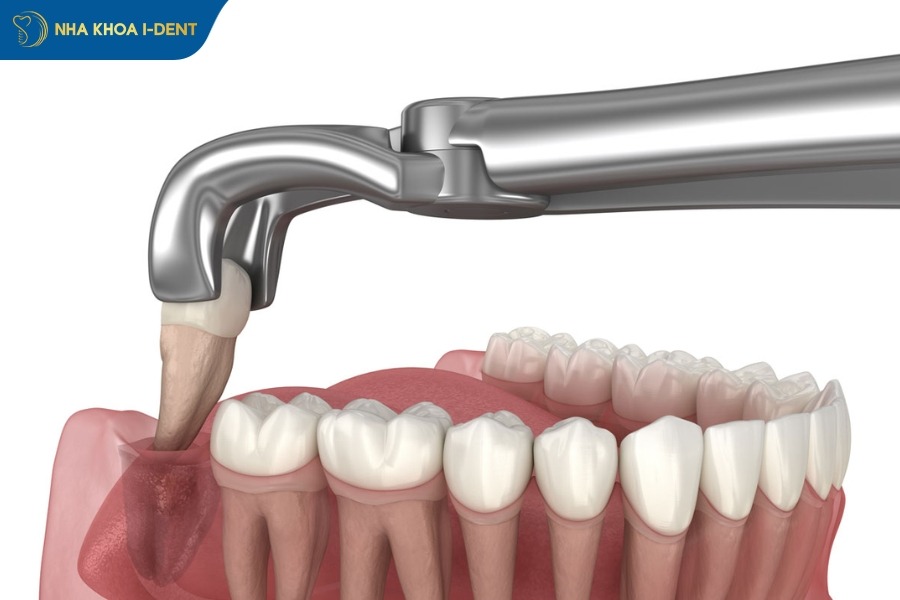 nhổ răng khôn để hạn chế bệnh lý răng miệng