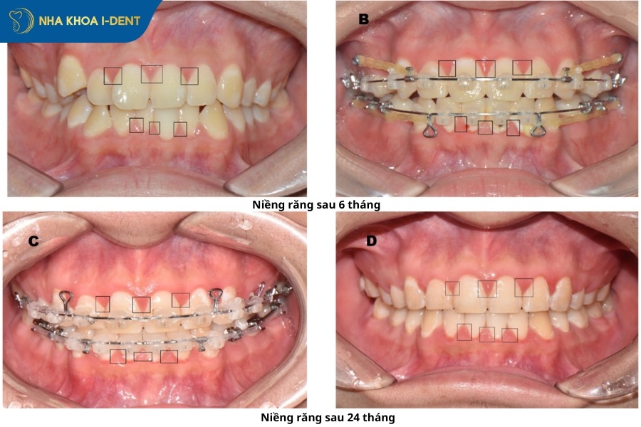 thời gian niềng răng trung bình