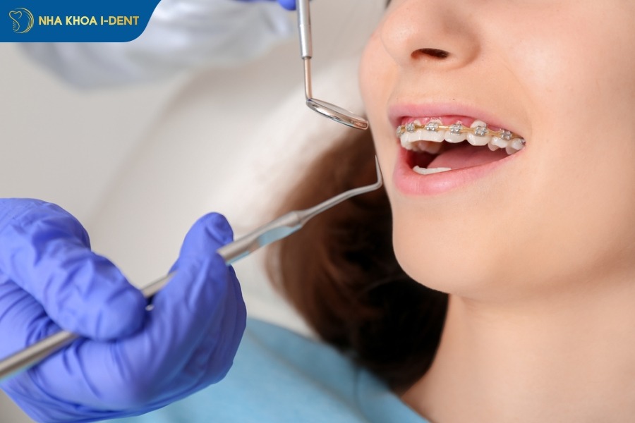 niềng răng bao lâu thì tháo được
