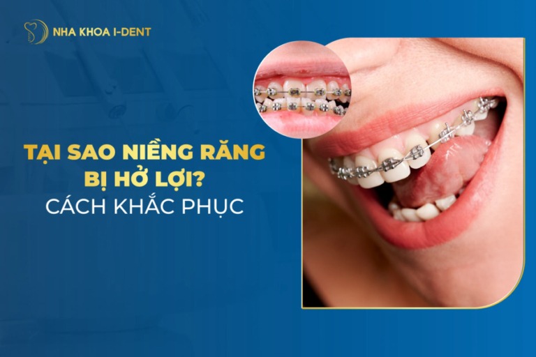 niềng răng bị hở lợi