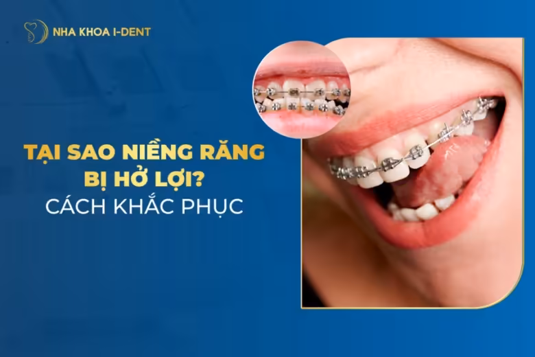 niềng răng bị hở lợi