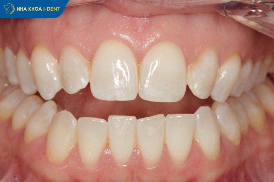 niềng răng cắn hở