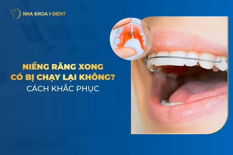 Niềng Răng Xong Phải Đeo Hàm Duy Trì Bao Lâu?
