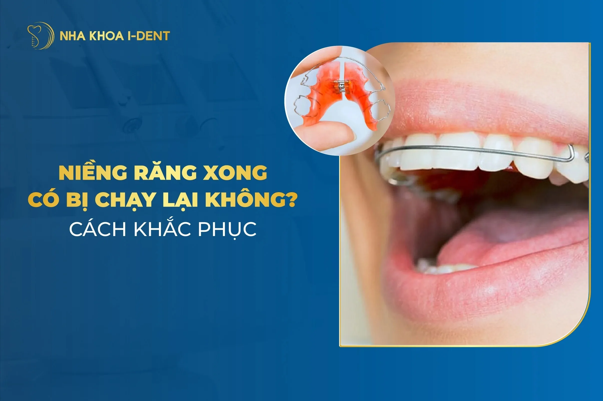 Niềng Răng Xong Phải Đeo Hàm Duy Trì Bao Lâu?