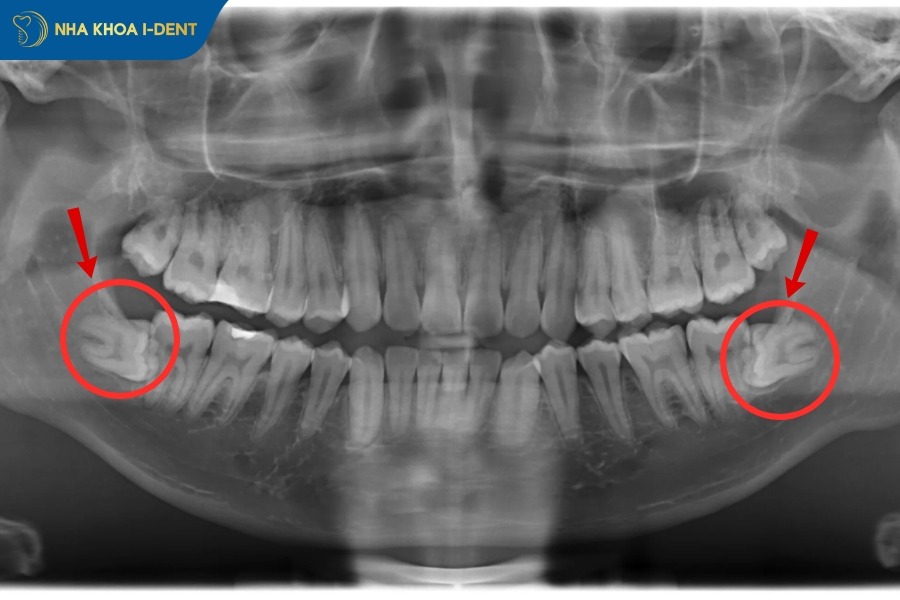 nhổ răng khôn mọc ngang
