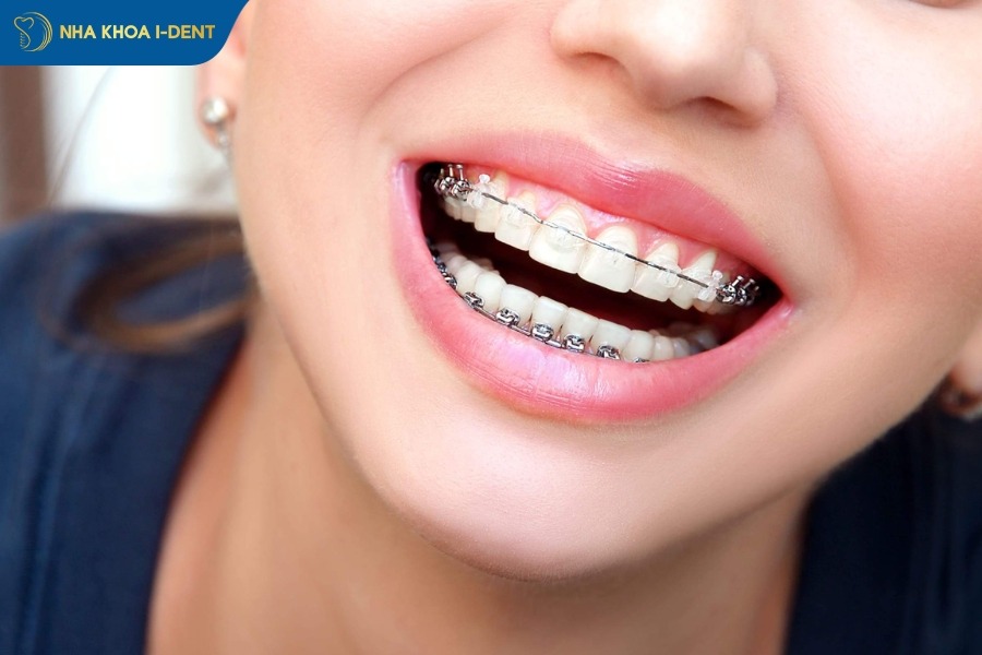 niềng răng có tác dụng thẫm mĩ