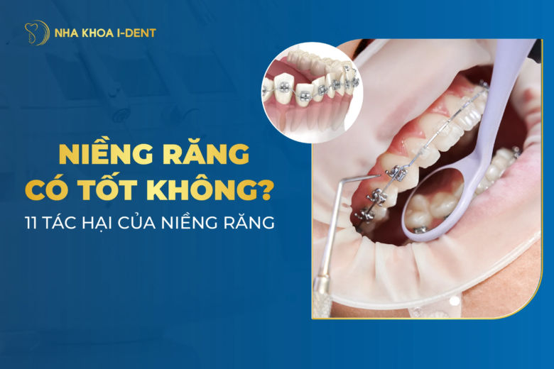 Niềng răng có tốt không? 11 Tác hại của niềng răng