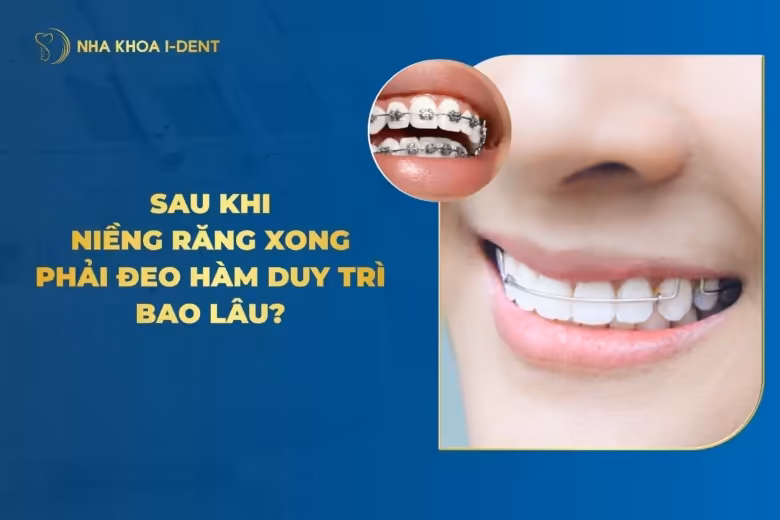 Niềng Răng Xong Phải Đeo Hàm Duy Trì Bao Lâu?