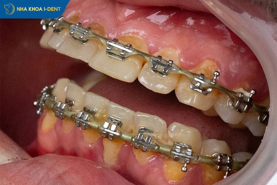 niềng răng hở lợi