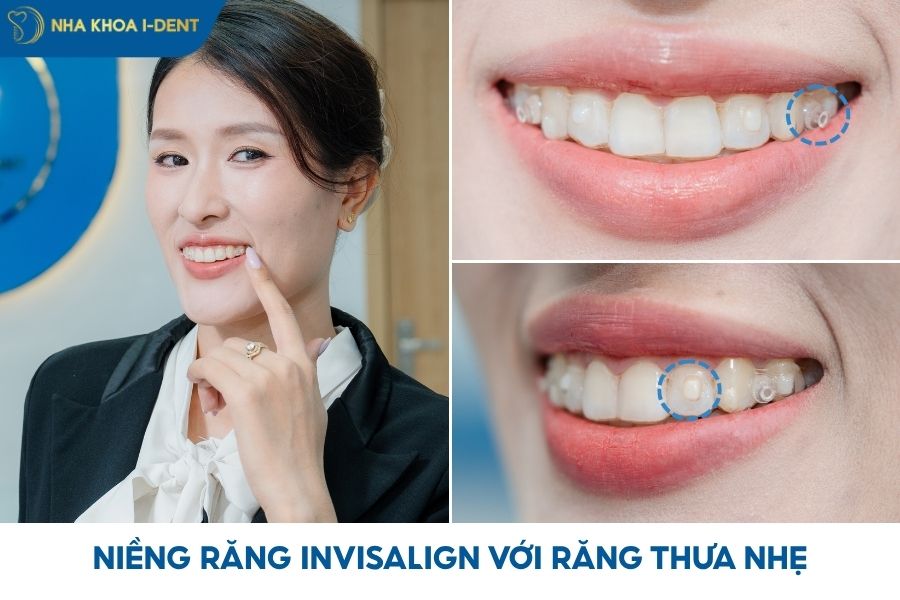 niềng răng invislaign mất khoảng bao lâu