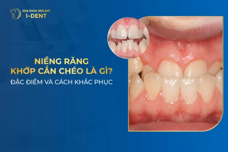 niềng răng khớp cắn chéo
